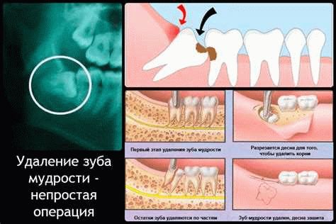 Получение больничного листа после удаления зуба мудрости и других стоматологических операций